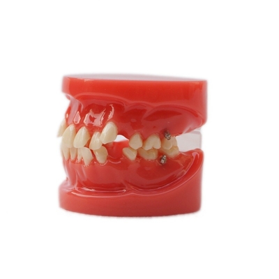 آموزش استفاده از دندان های دندانی مدل آموزش عملکردی دندان های ارتودنسی بدون براکت