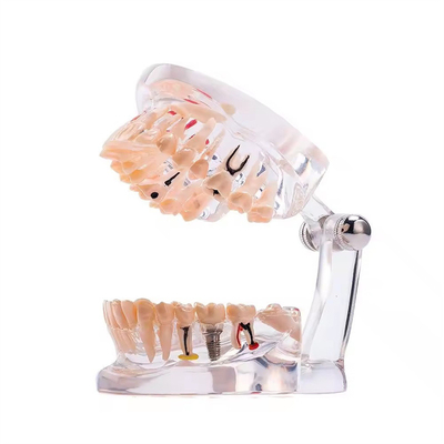 مدل دندان بیماری ایمپلنت کامل ماه با 32 دندان، طراحی شفاف، مدل آسیب شناسی دندان